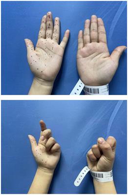 Neuralgic amyotrophy with multiple hourglass-like constrictions of anterior interosseous nerve: a case report